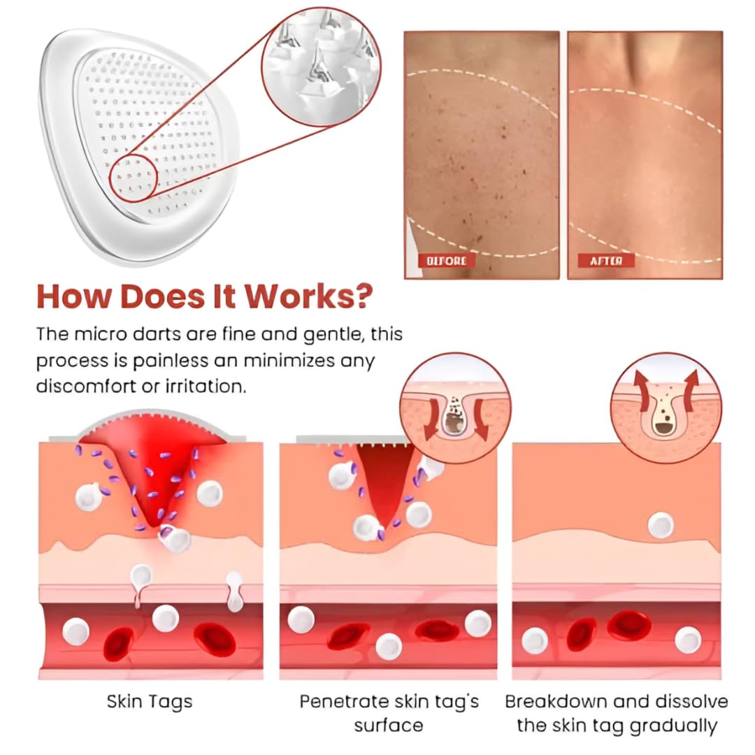 (BUY 1 GET 2) TagAway® - Premium Skin Tag Remover Patches (Pack of 144 Patches)