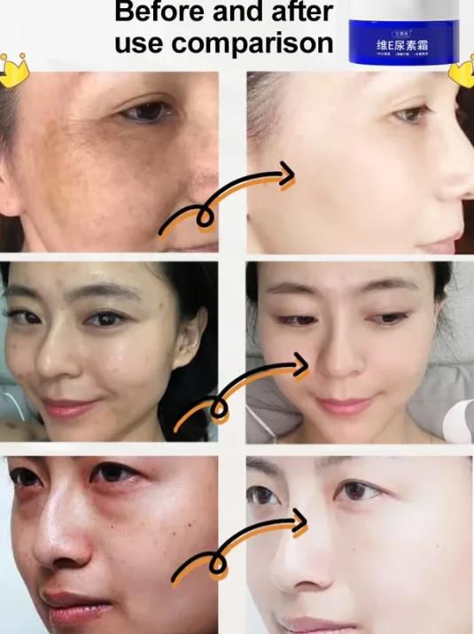 Spot Fading Urea Cream – Deep Moisture & Nourishment (Buy 1 Get 1 Free)