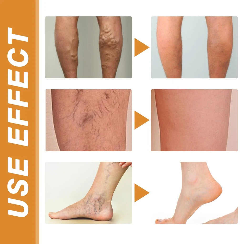 (BUY 1 GET 1 FREE) VeinGuard® - Varicose Vein Relief Spray