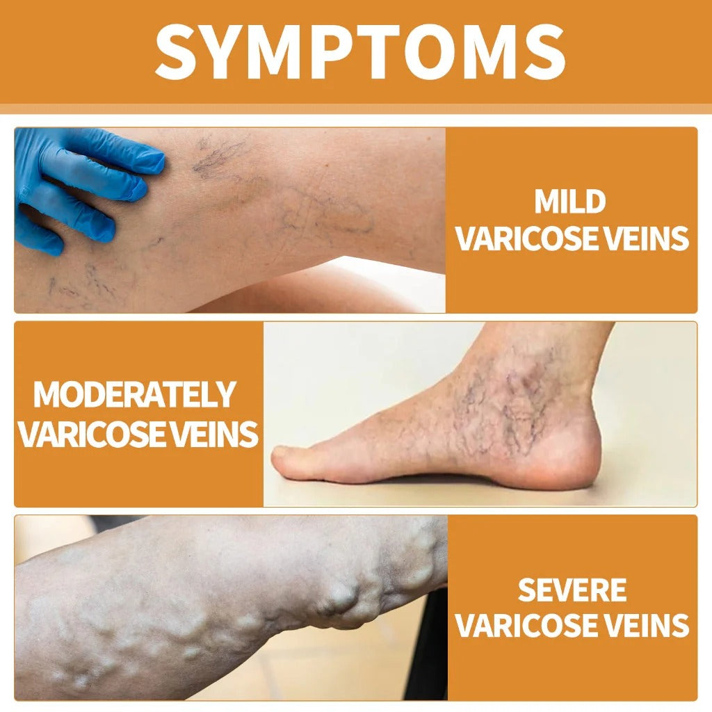 (BUY 1 GET 1 FREE) VeinGuard® - Varicose Vein Relief Spray