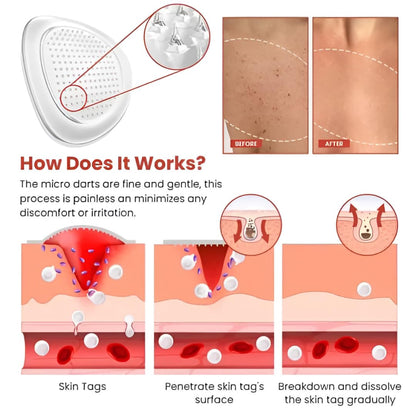 (BUY 1 GET 2) TagAway® - Premium Skin Tag Remover Patches (Pack of 144 Patches)