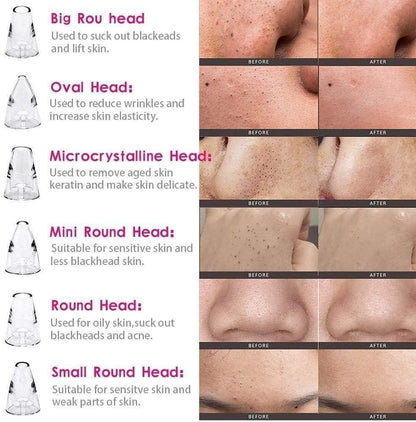 PorePerfect® - 6 in 1 Multifunctional Blackhead Remover Tool