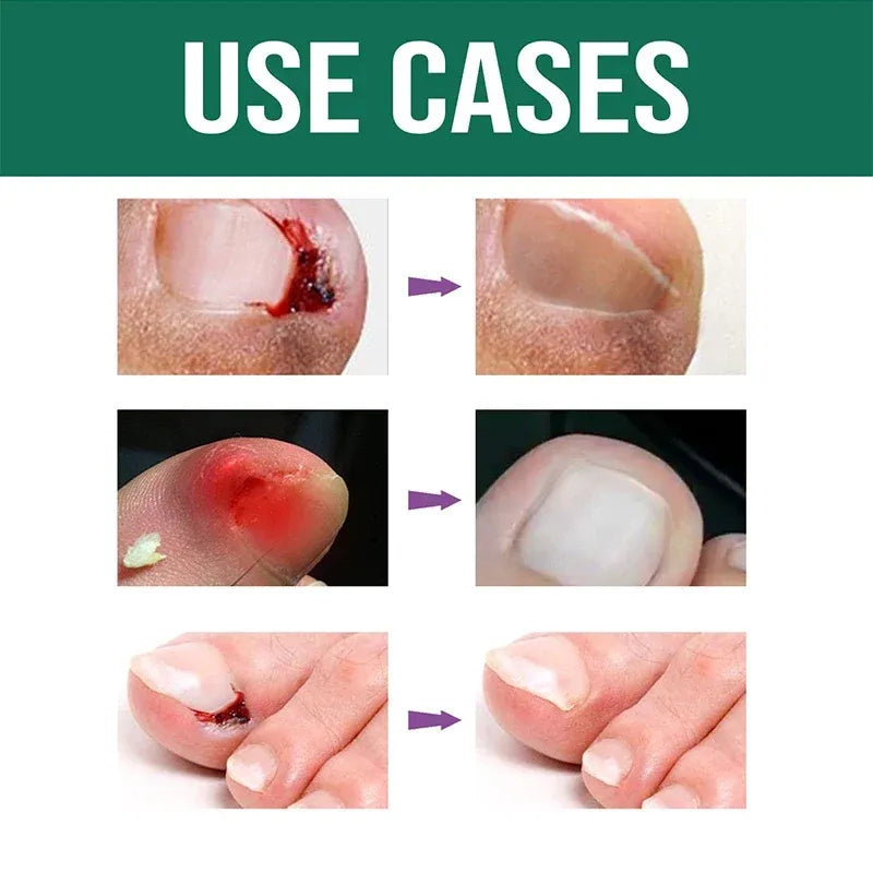 (BUY 1 GET 1 FREE) Redapple Anti-Paronychia Relief Oil