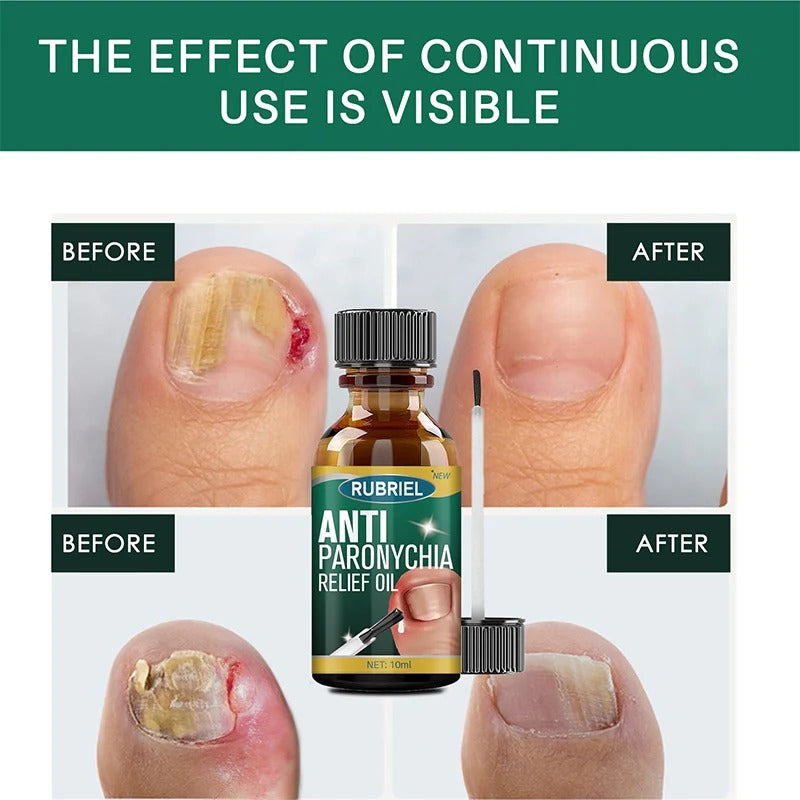 (BUY 1 GET 1 FREE) Redapple Anti-Paronychia Relief Oil