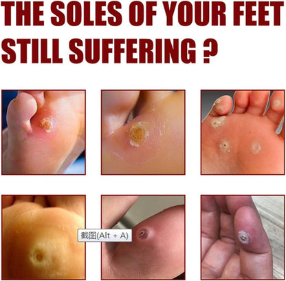 CornEase® - Advanced Feet Corn Removal Serum