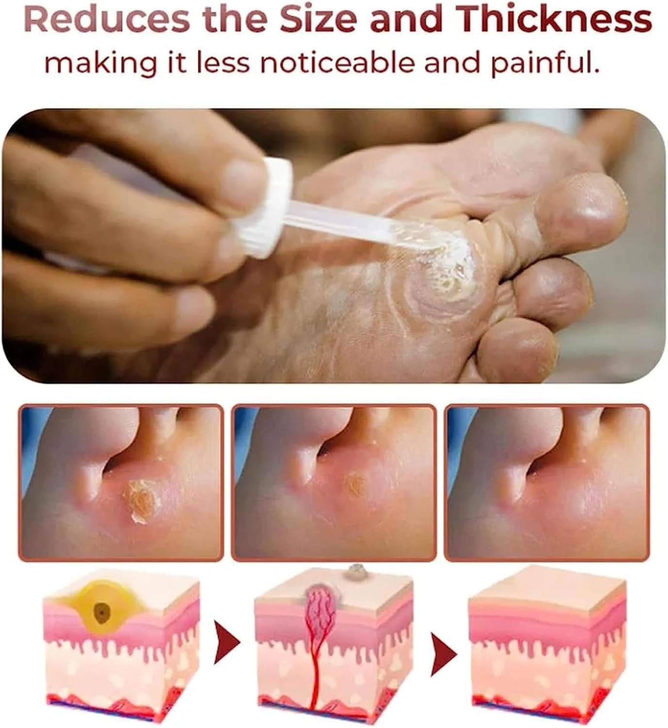 CornEase® - Advanced Feet Corn Removal Serum