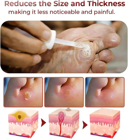CornEase® - Advanced Feet Corn Removal Serum