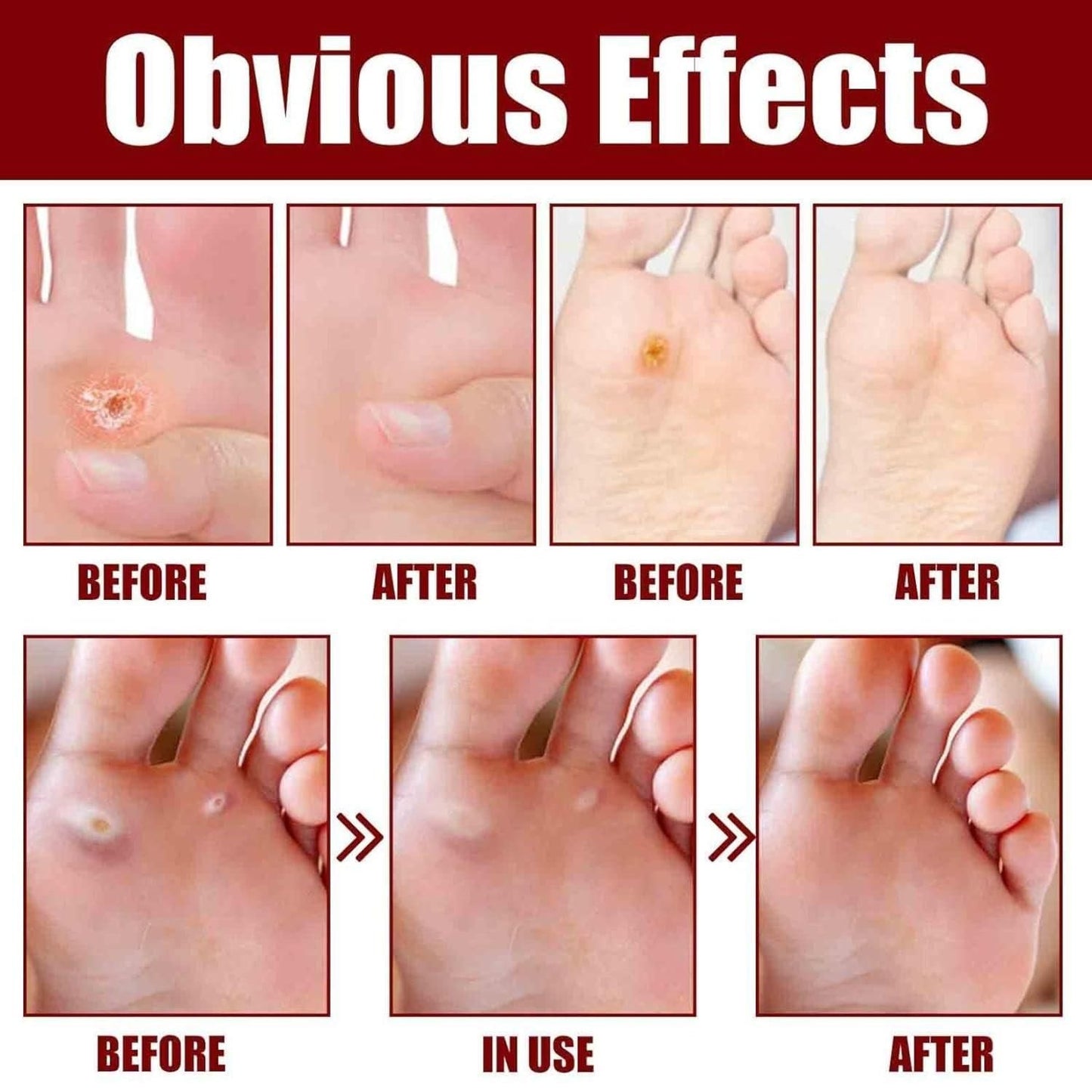 CornEase® - Advanced Feet Corn Removal Serum